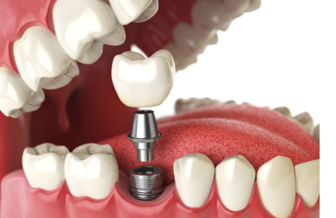 Dental Implant Restoration