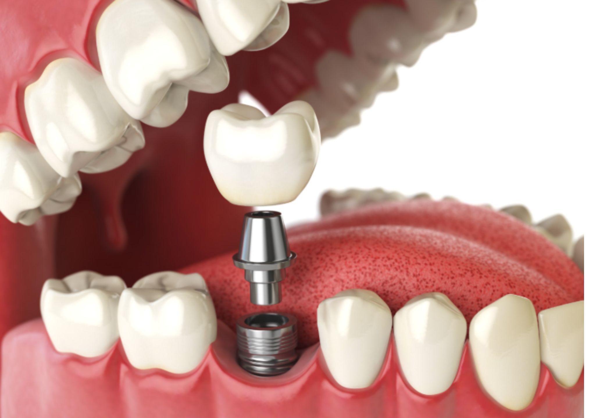 Dental Implant Restoration