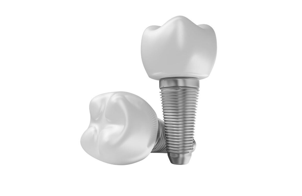 Dental-Implants
