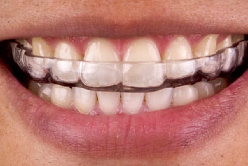 Mouth-Guard