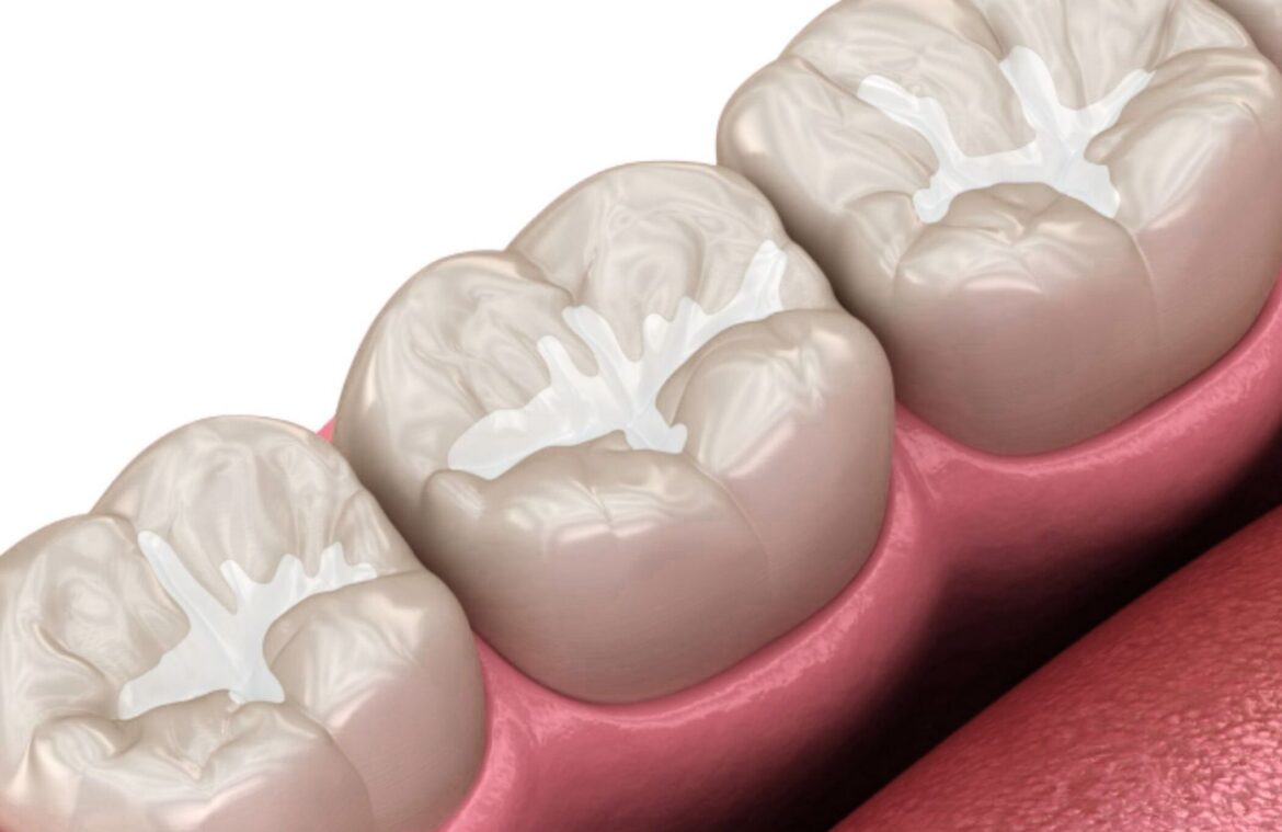 Sealants