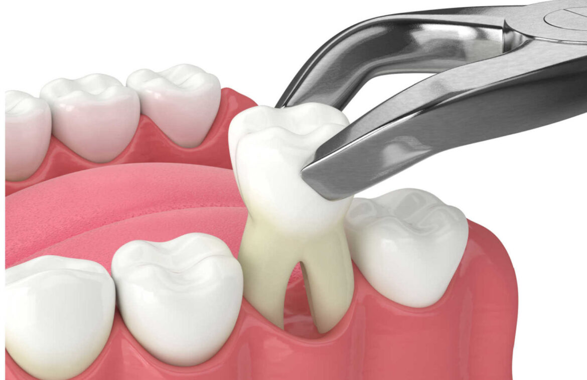 Tooth Extractions
