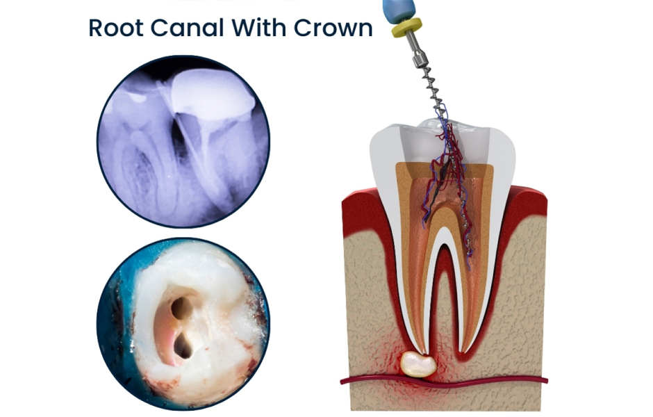 Root-Canals