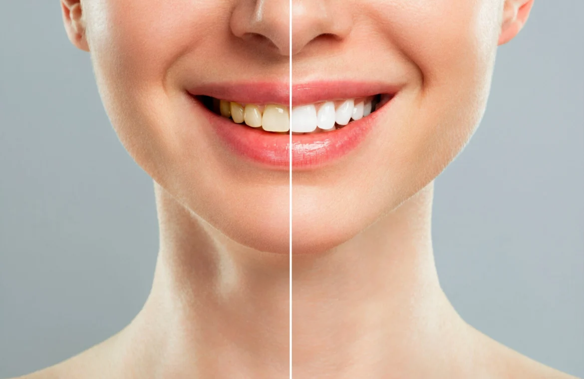 Teeth Whitening Littleton, CO | Southwest Family Dentistry