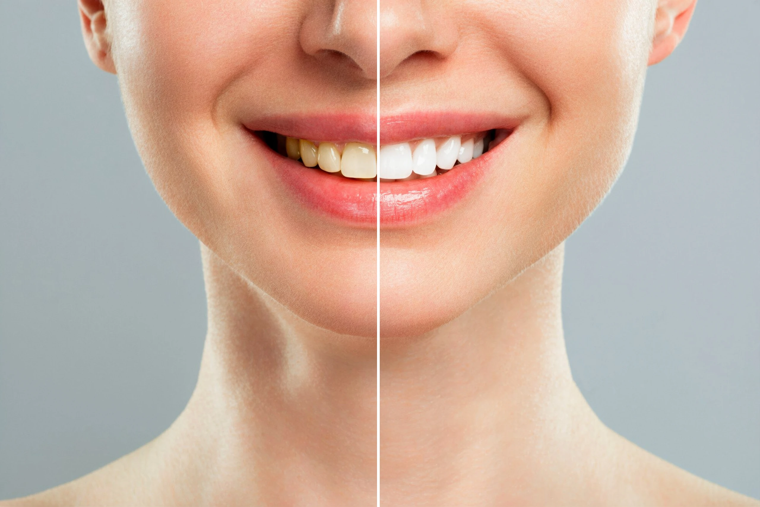 Teeth Whitening Littleton, CO | Southwest Family Dentistry