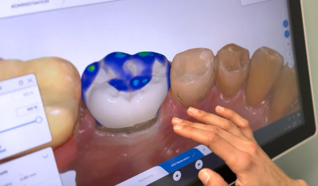 Cracked or Chipped Tooth?