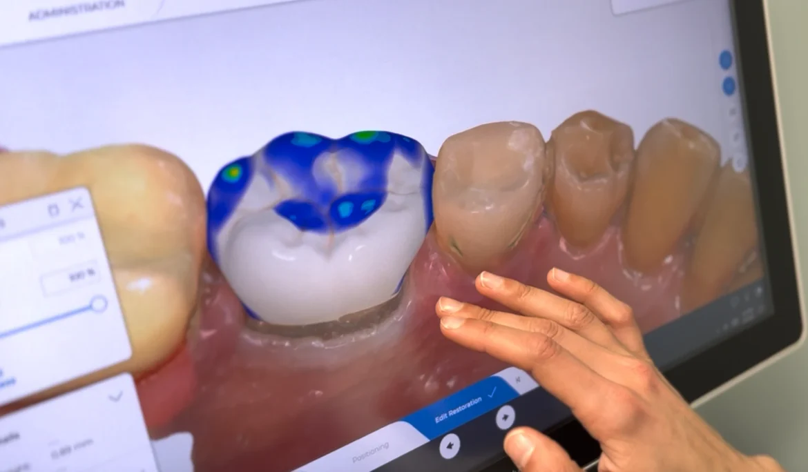 Same-day CEREC crown for a cracked tooth in Littleton, CO