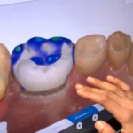 Same-day CEREC crown for a cracked tooth in Littleton, CO