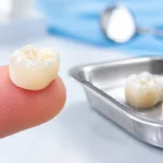 Dental crown that came off, ready to be re-cemented in Littleton, CO
